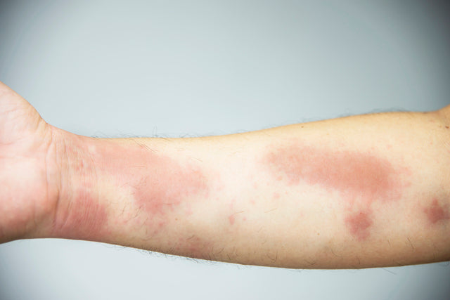 Eczéma - Psoriasis
